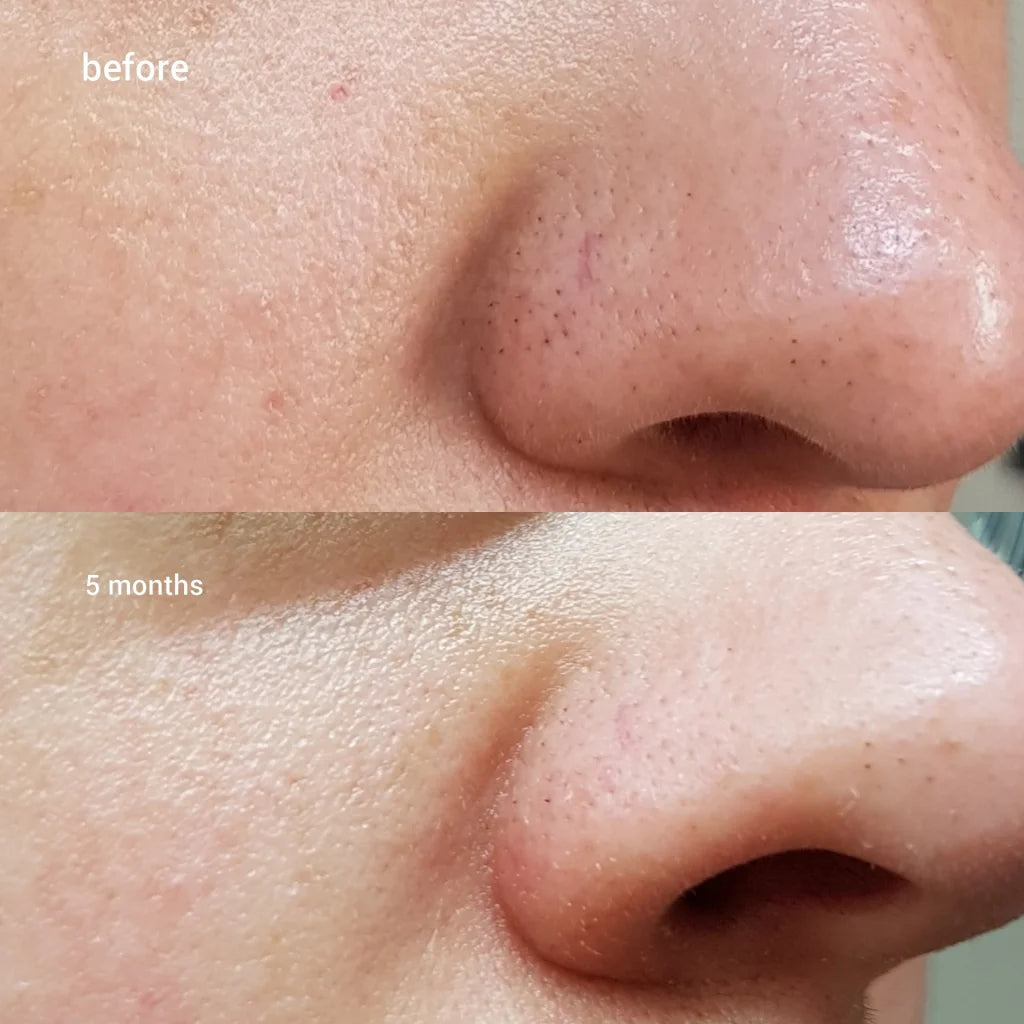 Cosrx BHA Blackhead Power Liquid